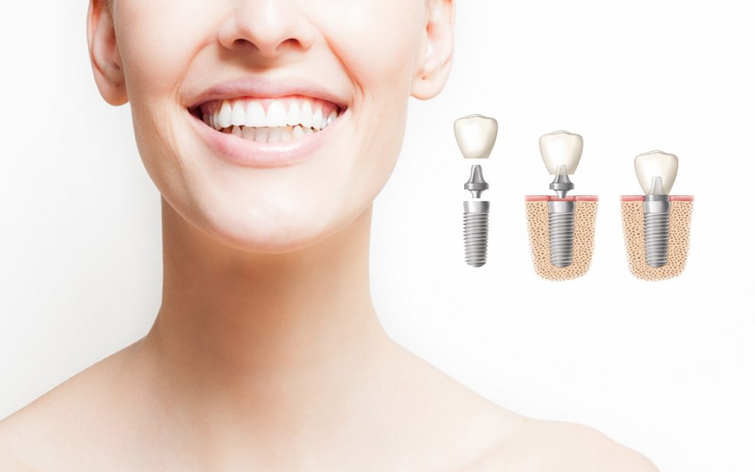 Todo lo que debes saber de los implantes dentales